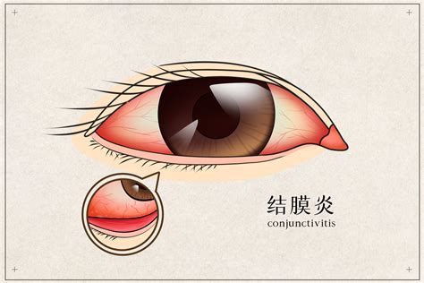 “阳了”后出现眼睛不适，多人中招 ！警惕新冠病毒眼病-综合知识-