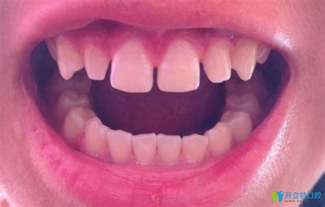 门牙浮起是为什么呢,牙齿浮起来是什么意思,什么是牙齿浮起感_大山谷图库
