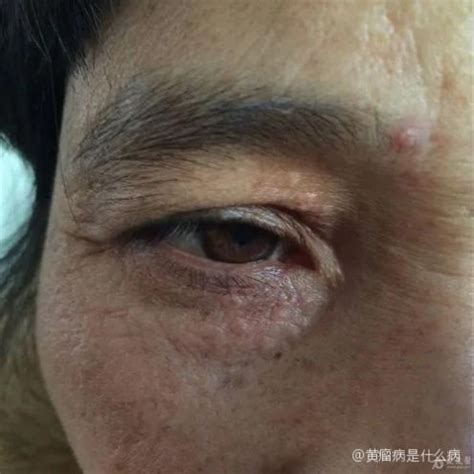 黄瘤病图片