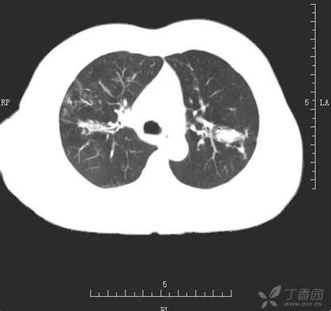 支气管肺癌的影像特征必看！ - 知乎