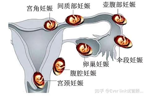 如何看孕囊？孕囊大小对照表快来看看！|孕囊|胎囊|B超_新浪新闻