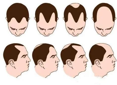 35岁男子被雄激素性脱发困扰多年，药物治疗长出头发！-有来医生