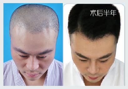 植发案例-种植头发-对比效果图-发友网