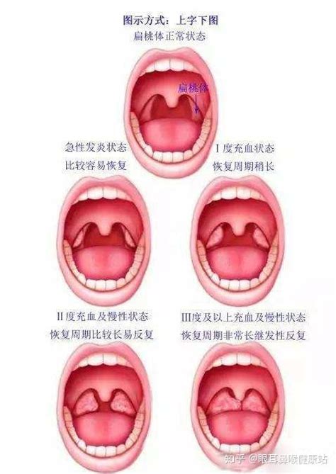 腭咽弓发炎图片