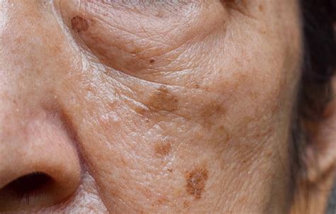 脸上老年斑消除最好的方法是什么？ | 说明书网