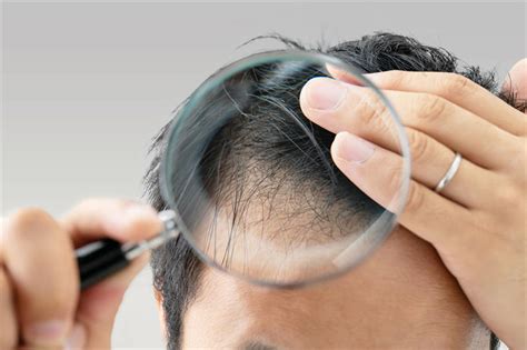 每天掉多少根头发算脱发？专家回应：超过100根(含视频)_手机新浪网