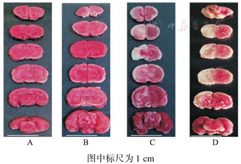 PSD-95抑制剂ZL006对新生大鼠缺氧缺血性脑损伤的作用探讨