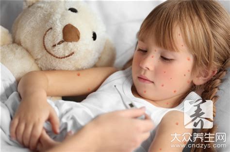 【小孩起水痘】小孩出水痘的治疗方法 - 水簇养生网