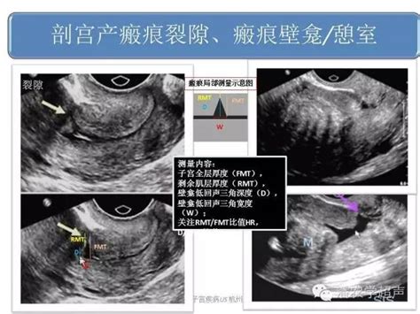 瘢痕子宫图片