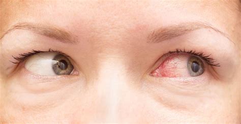 长期用眼，眼睛干涩，布满红血丝，视力下降，每天吃叶黄素酯片会有什么变化？！ - 知乎