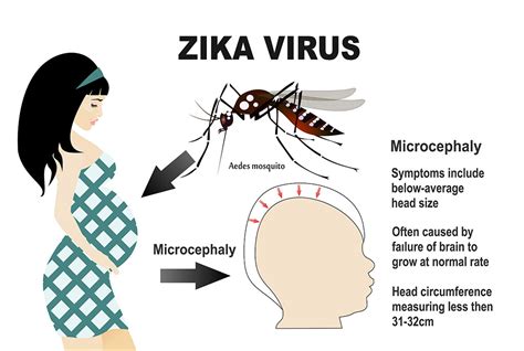 La amenaza del zika sigue latente y sus consecuencias a largo plazo son ...