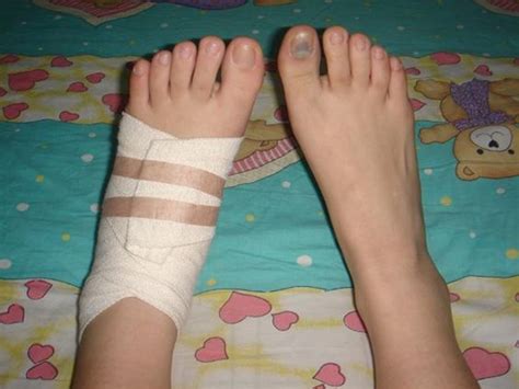 女生扭伤脚受伤包扎图片_女生脚扭伤的真实图片 - 随意云