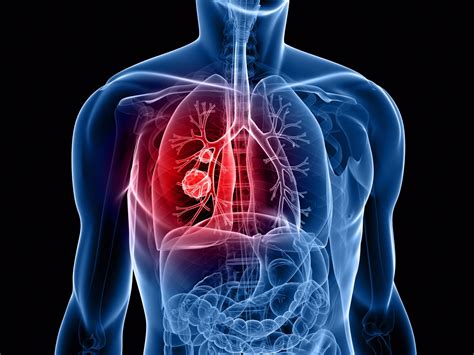 肺癌早期的8个信号, 肺癌扩散的5大征兆,千万别忽视!|Microsoft|肺癌|信号_新浪新闻