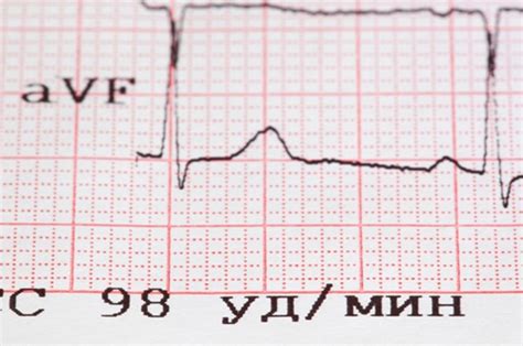 心率正常值范围是多少-心率正常值范围介绍-六六健康网