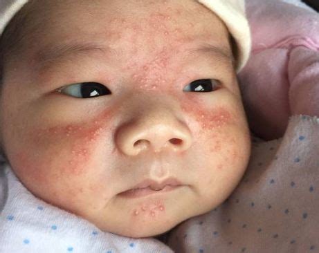 宝宝脸上每到冬天都会一片一片的泛红，医生检查说是湿疹，去了很多医院，也试了很多土方，也用了很多药膏 - 百度宝宝知道