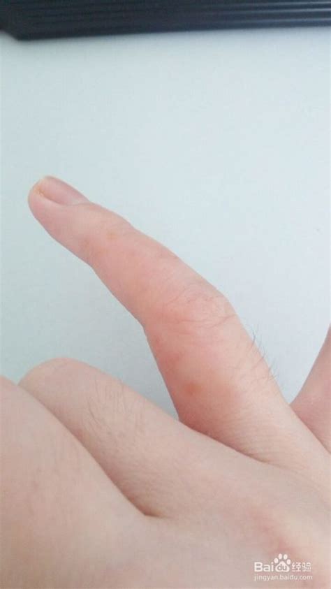 手指水泡型湿疹图片 (19)_有来医生