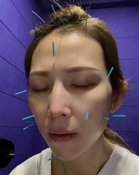 熊黛林针灸图片