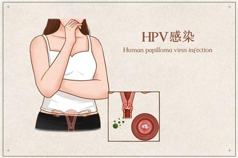 低危型HPV感染是什么意思_中华康网