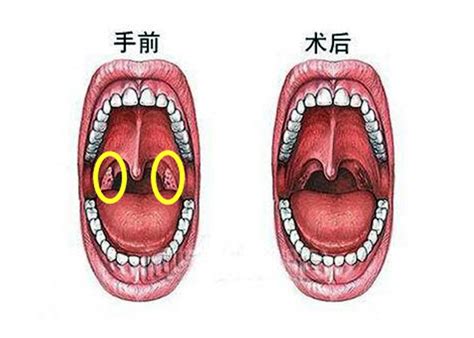 慢性扁桃体炎引起舌底部糜烂硬化图片_有来医生