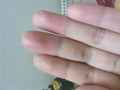 手指湿疹症状图片 (31)_有来医生