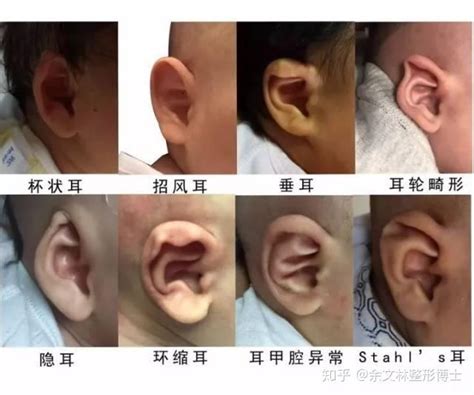 耳朵软骨突出图片
