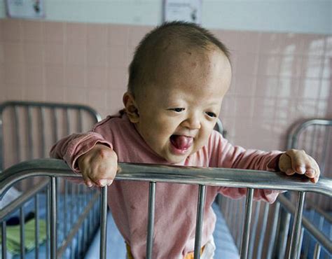 “橙剂”遗害：越战化学试剂致婴儿畸形