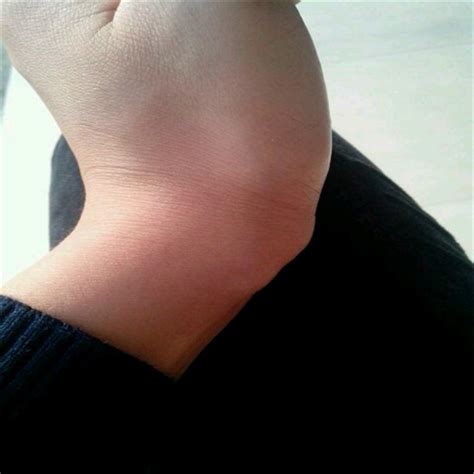 手背腱鞘囊肿图片