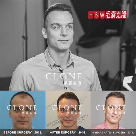 毛囊克隆技术成功引进，给无数脱发人群带来曙光 | 中国周刊
