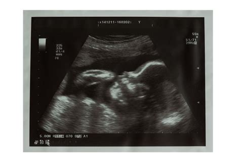 【孕期彩超标准数据】【图】孕期彩超标准数据 为你解读胎儿小常识_伊秀亲子|yxlady.com