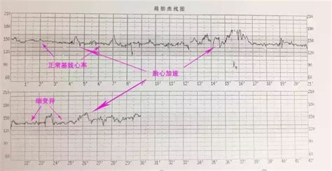 胎心监护图怎么看「最新教你看懂胎心曲线」 - 寂寞网