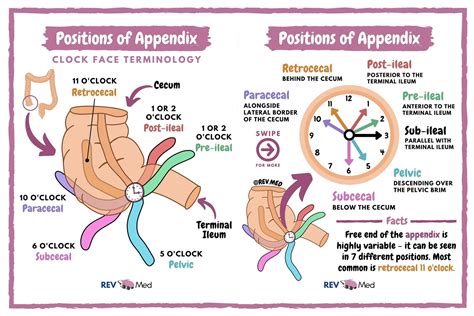 Appendix Positions - Retrocecal (*most common) - ... | GrepMed