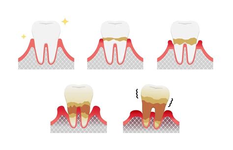 【廊坊】成年人牙周病引发的牙齿松动应该怎么处理 - 知乎