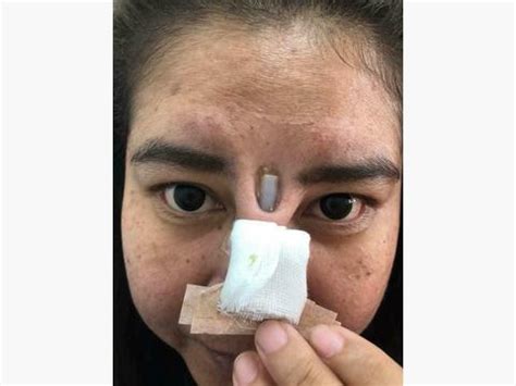 日记记录北京美容诊所做的假体隆鼻，我的真实案例_假体隆鼻_整形经历_整容通app