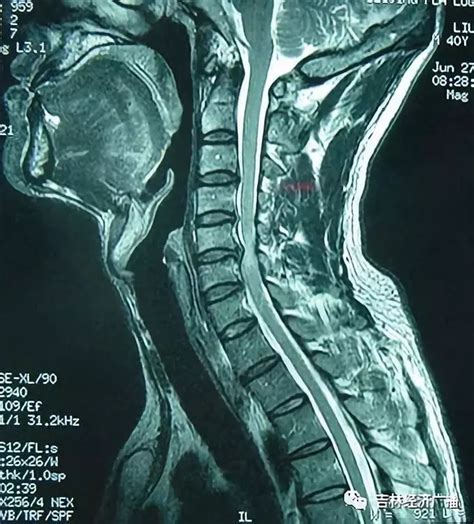 颈椎核磁共振图片,正常颈椎核磁共振图,颈椎磁共振图片详解(第3页)_大山谷图库