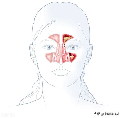 鼻炎鼻塞怎么治疗最有效（鼻炎，鼻塞反复不好，多是阳气不通，送你一个方子，通阳、通鼻腔） | 说明书网