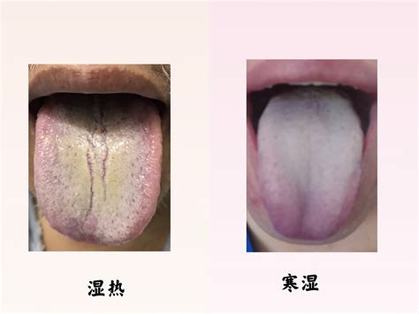 湿热舌头症状图片