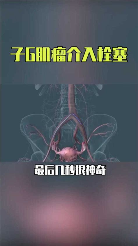 栓塞微球-子宫动脉栓塞（UAE）新突破 ——【海杰亚科研资讯】第223期-海杰亚（北京）医疗器械有限公司