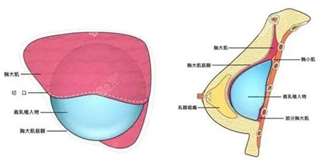 李高峰医生隆胸技术咋样?对比郝永生做的隆胸谁更好,乳房对比照-8682赴韩整形网