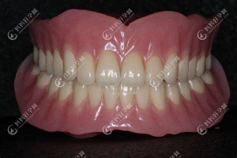 种植覆盖义齿（全口）一例---牙医风涛-商丘牙医-靳风涛-的博客-KQ88口腔博客