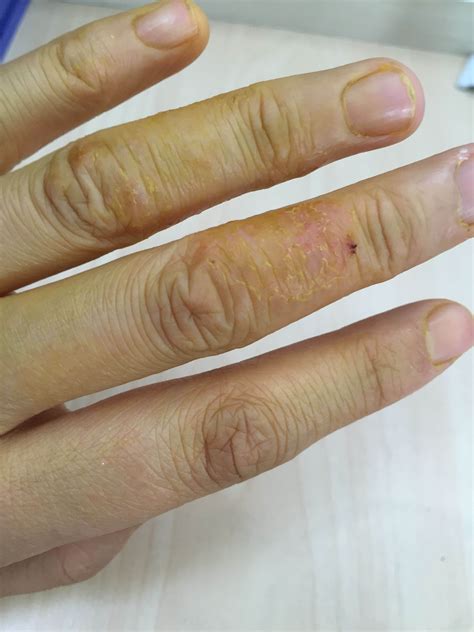 手指角质化湿疹,手指角质化_大山谷图库