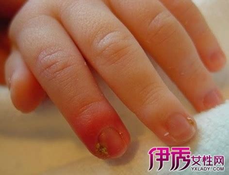 【咬指甲的危害图片】【图】咬指甲的危害图片 了解多一点危害让你远离细菌疾病(2)_伊秀健康|yxlady.com