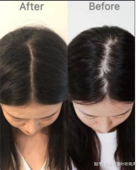 激光生发和植发有什么区别?两者区别不仅在治脱原理和价格,脱发治疗-8682赴韩整形网