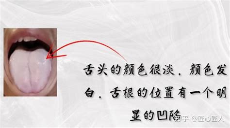 阴虚舌苔图片