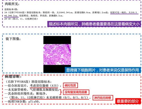 肺癌本可治，重在发现早_科普中国网