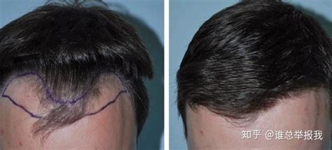 头发种植后两大误区，头发种植靠不靠谱 - 知乎