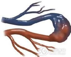 动静脉内瘘图片