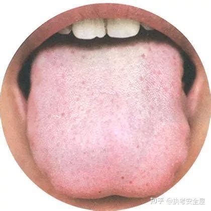 医生受打舌环启发 给自己舌背做手术治打鼾(图)_手机新浪网