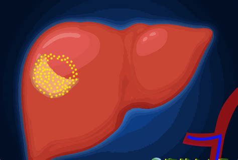 《微视介》第三期—介入如何治疗肝癌？ - 肝癌介入MDT联盟