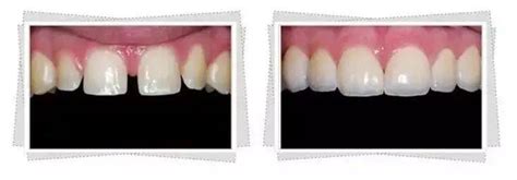 5、正畸治疗关闭牙缝：将金属正畸托槽粘贴于牙面上，利用正畸矫正的方法关闭缝隙，恢复整个牙列的牙弓形态，时间会相对比较长一些。