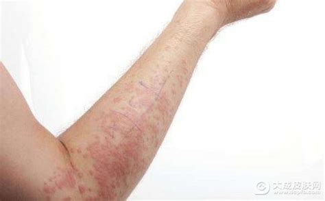 慢性湿疹疾病有办法预防吗_健康常识_大成皮肤网